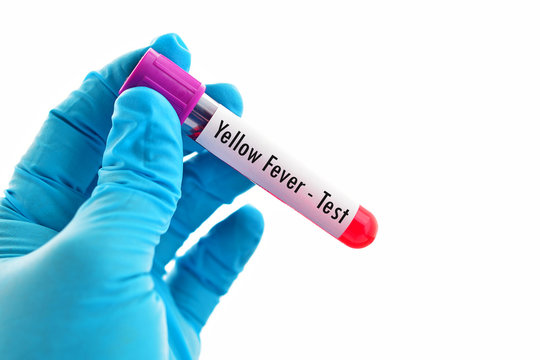 Test tube with blood sample for yellow fever test
