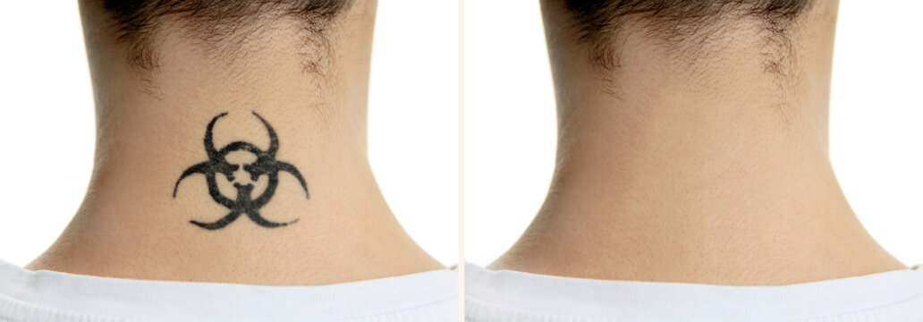 Naklejki Tattoo on male neck. Laser tattoo removal concept