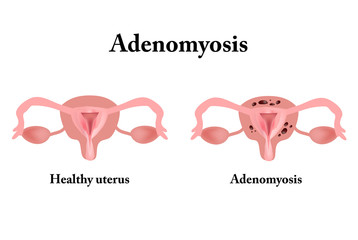 Endometriosis. The structure of the pelvic organs. Adenomyosis. The endometrium. Vector illustration - obrazy, fototapety, plakaty