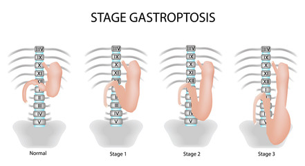 Gastroptosis stomach. The omission of the stomach. Stage gastroptosis. Vector illustration on isolated background