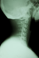 X-rays used in the treatment