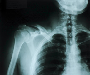 X-rays used in the treatment