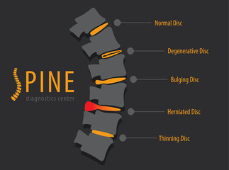 Spine anatomy disc degeneration, medical conceptual infographic vector