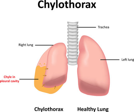Chylothorax