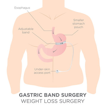Gastric Band for Weight Loss.  If you Tighten or Loosen it, It Lets More Food in the Lower Stomach.  The Doctor Assistant Adjusts the Tightness of the Band with a Port that's Under the Skin.