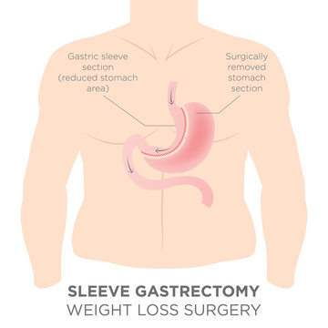Stomach Staple Bariatric Surgery Resulting in 1/4 of the Stomach Removed.