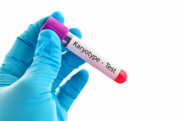 Fototapeta premium Blood sample for karyotype (abnormal chromosome study) testing 