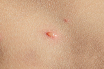 Chicken pox on child skin