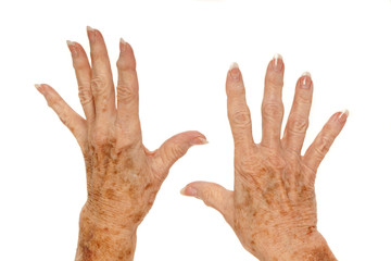 Medical: Female senior citizen hand with Rheumatoid Arthritis and age spots (also known as liver spots, Solar lentigo, Lentigo senilis and Senile freckle) shot on a white background