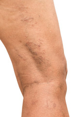 Varicose veins on the legs of middle-aged women.