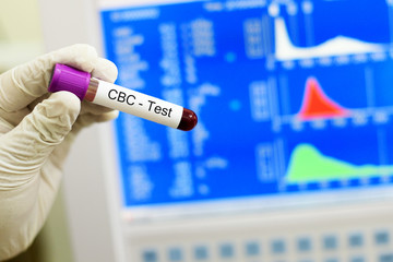 Blood sample for complete blood count (CBC) test
