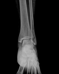 Human foot ankel and leg xray picture.