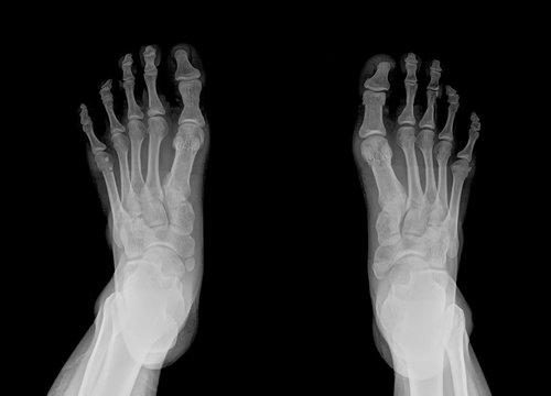 human right and left foot ankle xray picture