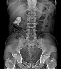 X-ray lumbo-sacral spine and pelvis