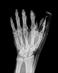 Broken hand after external fixation on roentgenogram