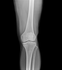 Right knee joint X-ray photos, the front position