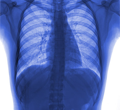 View of a human x-ray film, taken to examine the lungs