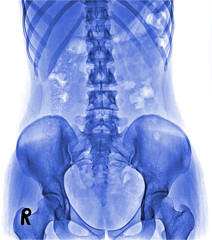 X-ray lumbo-sacral spine and pelvis