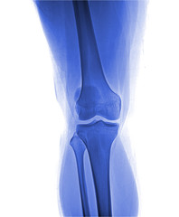 Right knee joint X-ray photos, the front position