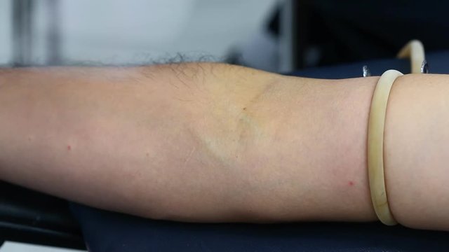 A large bore needle is inserted into the medial antecubital vein of the arm for blood donation