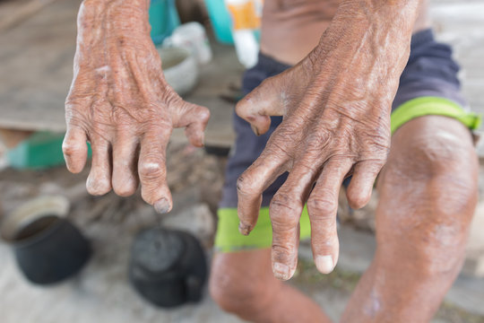 Hansen's disease,closeup hands of old man suffering from leprosy