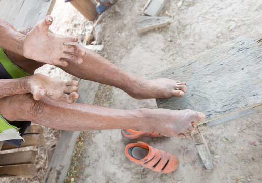 Hansen's disease,closeup hands of old man suffering from leprosy