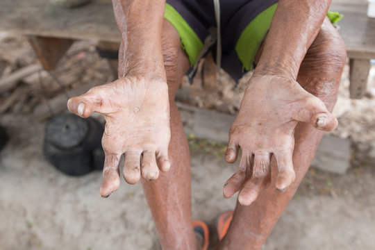 Hansen's disease,closeup hands of old man suffering from leprosy