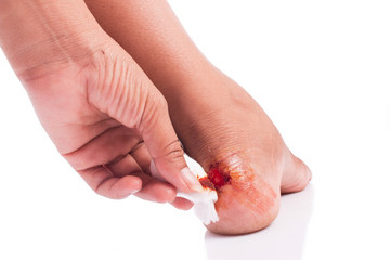 wound at heel