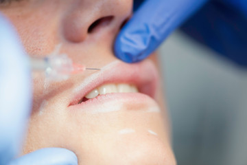Hyalurnic injection. Upper lip treatment