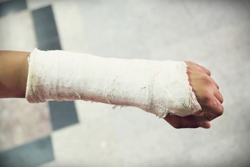 arm splint, be in plaster cast