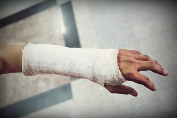 arm splint, be in plaster cast