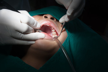 Close up of hands of dentist drilling teeth. Dentist holding mirror dental treatment