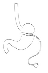 2d cartoon illustration of stomach with gastric band