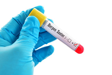Obraz premium Blood sample positive with herpes zoster test 