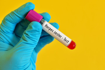 Obraz premium Blood sample for herpes zoster test 