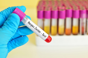 Naklejka premium Blood sample for herpes zoster test 