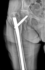 Upper part of broken human thigh with steel screw x-ray