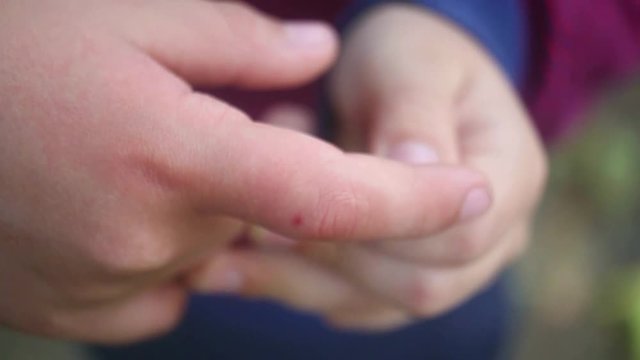Child was bitten by bee on finger unexpectedly. Boy showing his red finger. Close up of hands. Real time video.