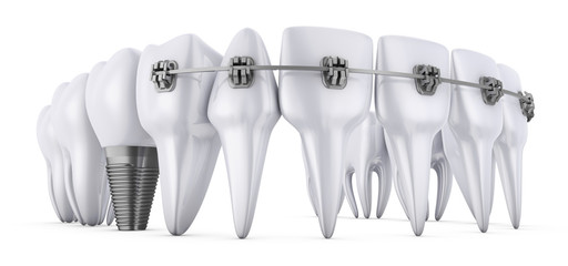 teeth and implant