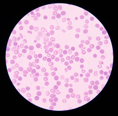 thalassemia
