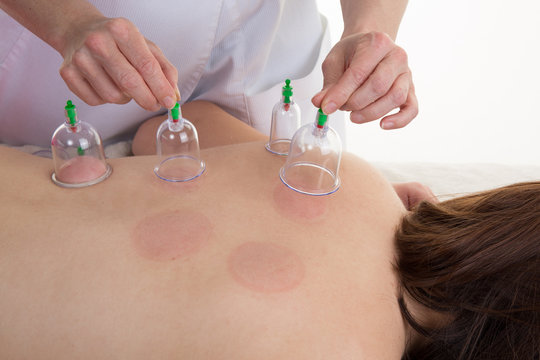 girl Chinese medicine cupping of the back of young woman