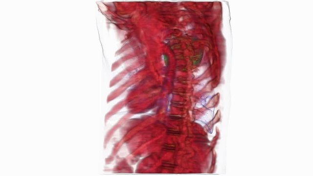 Graphic reconstruction of lung cancer