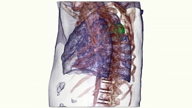 Graphic reconstruction of lung cancer