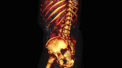 Large abdominal aortic aneurysm