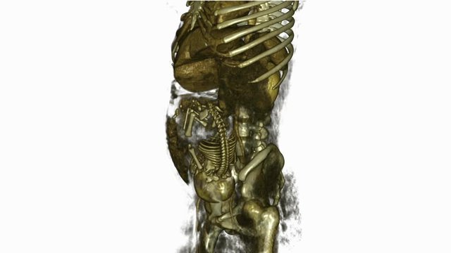 31 week pregnancy with fetus in occiput position