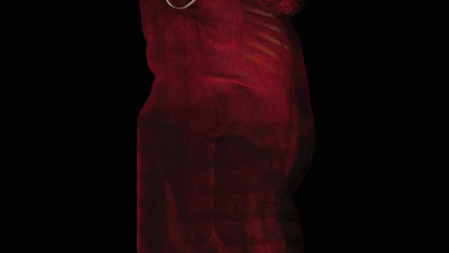 31 week pregnancy with fetus in occiput position