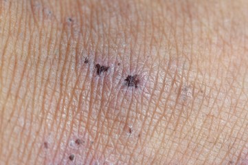 scar on human skin