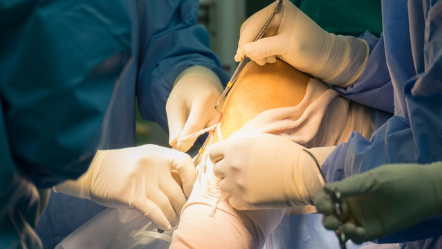 Preparation Tendon For ACLR (Arthroscopic ACL Reconstruction)