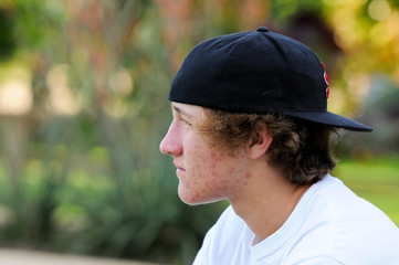 Teenage boy with acne and backwards baseball hat looking sideway