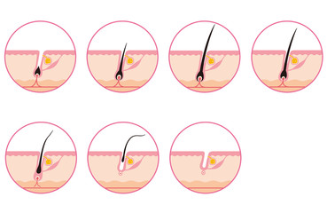 脱毛　毛周期　ヘアサイクル